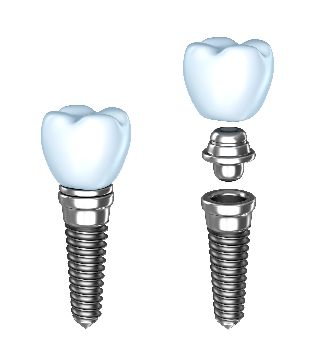 https://orthodontistnagpur.com/wp-content/uploads/2024/09/dental-implant-dentistry-dentures-human-tooth-implants-7f324e5cd771c2713fb880c128a2017c.png