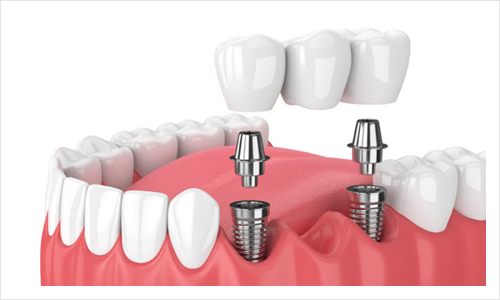 https://orthodontistnagpur.com/wp-content/uploads/2024/09/dentalbridges-1-1.jpg