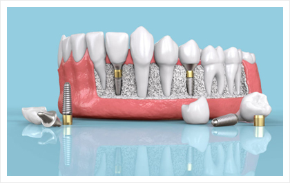 dentalimplant-1