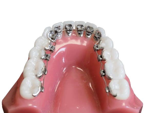 https://orthodontistnagpur.com/wp-content/uploads/2024/09/lingual-removebg-preview.png