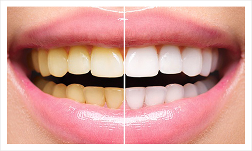 https://orthodontistnagpur.com/wp-content/uploads/2024/09/toothbleaching.jpg