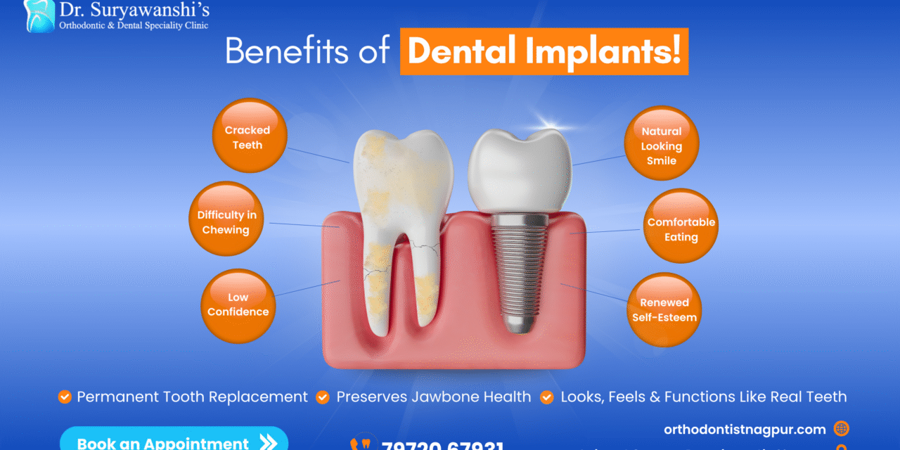 Benefits of Dental Implants