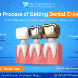 process of getting dental crowns at Dr. Suryawanshi's Orthodontic & Dental Specialty clinic